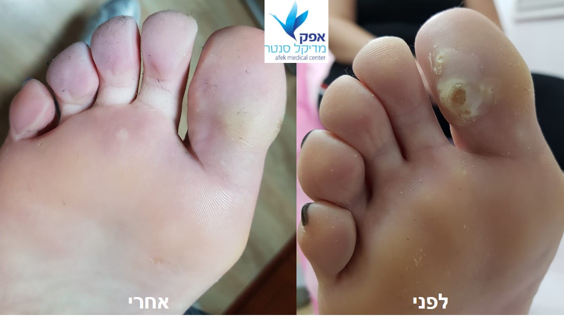 הסרת יבלות בלייזר בצפון, חיפה והקריות - אפק מדיקל סנטר - מומחים ברפואה ...